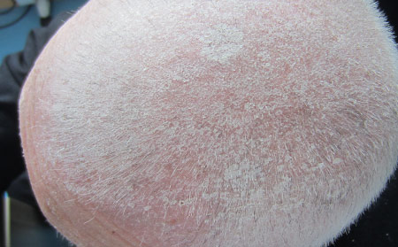 頭皮銀屑病與頭皮屑圖片癥狀如何區分有何不同