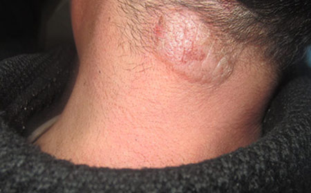 頭皮銀屑病與頭皮屑圖片癥狀如何區分有何不同