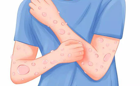 治療牛皮膚癬的方法