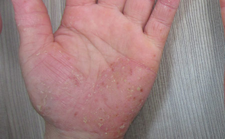 手上長牛皮病癬圖片