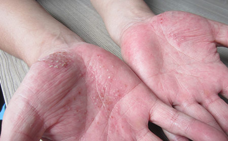 牛皮病癬有哪些類型