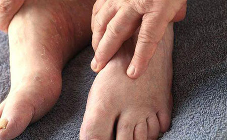 濰坊治銀屑病費用價格要花多少錢