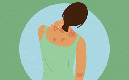 牛皮膚癬斑塊會變得發癢和剝落