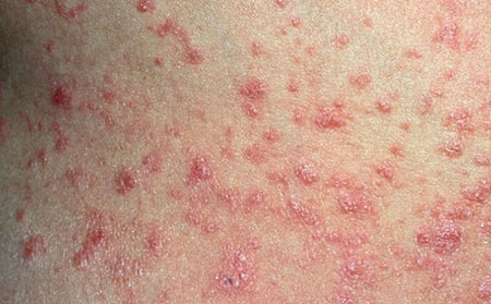 點滴狀銀皮膚癬