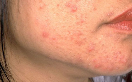 痤瘡