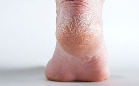 干燥、皸裂的皮膚