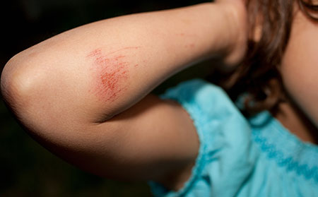 銀皮膚癬_減少擦傷