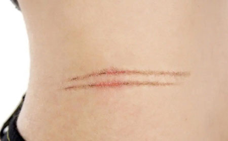 在Koebner現象中，皮膚受傷會引發銀屑病牛皮癬。