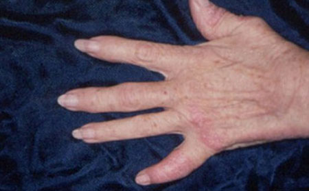 銀屑病關節炎的癥狀體征