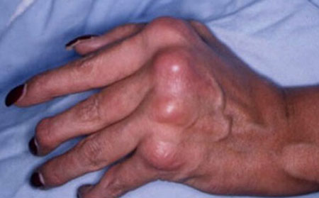 對稱性銀屑病關節炎的圖片癥狀