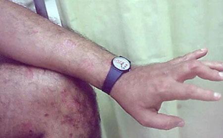 不對稱銀屑病關節炎的圖片癥狀