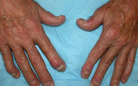 遠端指間優勢的圖片癥狀