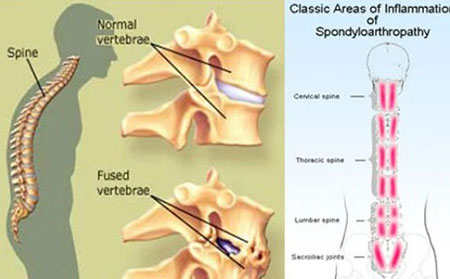 脊椎炎的圖片癥狀