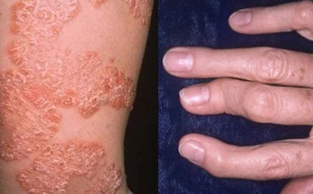 患銀屑病關節炎的原因