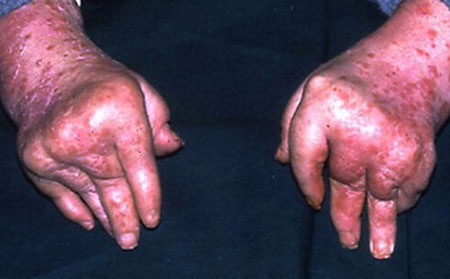 斑塊狀銀屑?。▽こＰ豌y屑病）