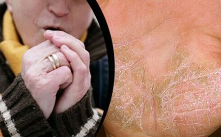 寒冷的空氣、干燥的溫度和減少的陽光都會導致冬季牛皮癬發作。