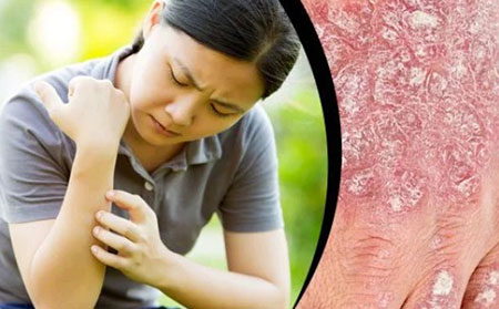 女性似乎特別容易經歷牛皮癬發作。