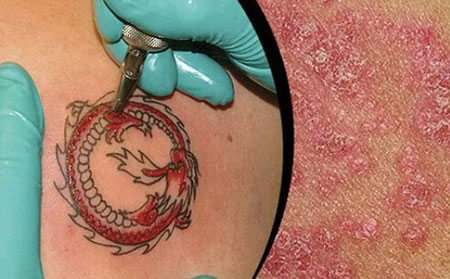 一些銀屑病患者在紋身后10到14天會出現新的銀屑病病變。