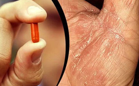 一些藥物可能會引發牛皮癬發作或使牛皮癬惡化。