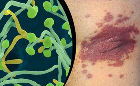 鏈球菌感染可能是點狀銀屑病發病的誘因
