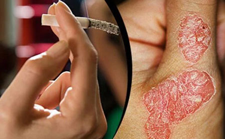 吸煙會大大增加銀屑病的風險，并使疾病變得更糟。