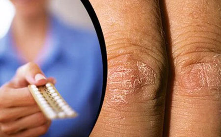 激素變化影響銀屑病發作的嚴重程度。