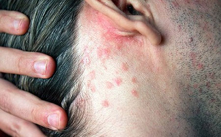 點滴狀銀屑病,點狀銀屑病,滴狀銀屑病,