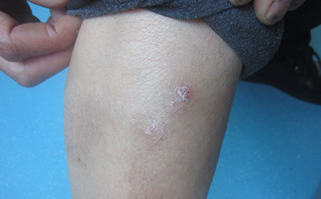 濰坊什么醫院看銀屑病好