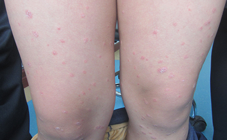 濰坊銀屑病醫(yī)院是正規(guī)醫(yī)院嗎