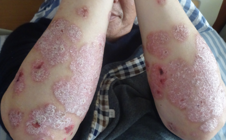 濰坊的銀屑病醫院哪家較為專業