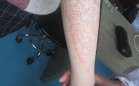 濰坊牛皮癬醫院治療牛皮癬效果好