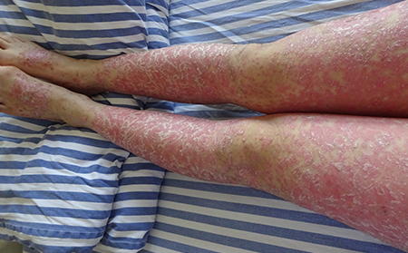 哪家濰坊治療牛皮癬醫院好啊