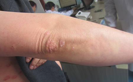 濰坊哪里有治療牛皮癬比較好的醫(yī)院