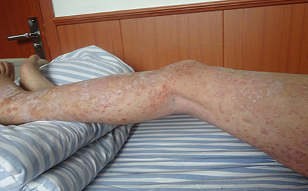 濰醫(yī)牛皮癬醫(yī)院如何選擇