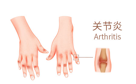 牛皮癬關(guān)節(jié)炎