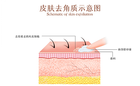 牛皮膚癬鱗狀皮膚去角質(zhì)