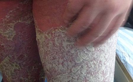 膿皰型銀屑病圖片癥狀