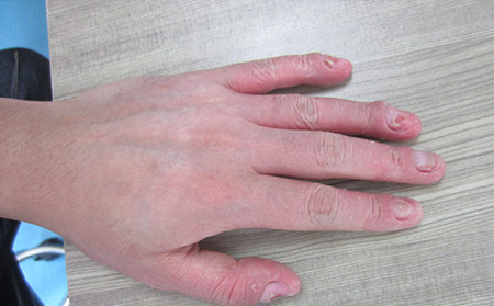 干癬性關節炎是與牛皮癬相關的炎癥性關節疾病