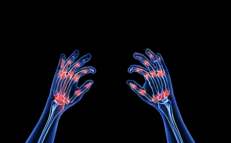 銀屑病關節炎手指腫脹