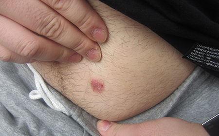 點滴狀銀屑病圖片癥狀