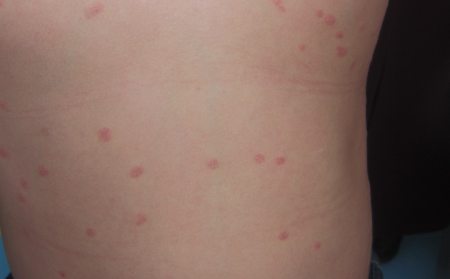 什么影響著點滴狀牛皮癬的恢復