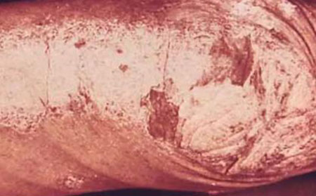 斑塊狀牛皮膚癬是常見的形式