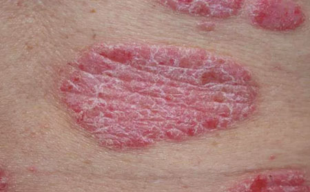 銀屑病圖片的癥狀