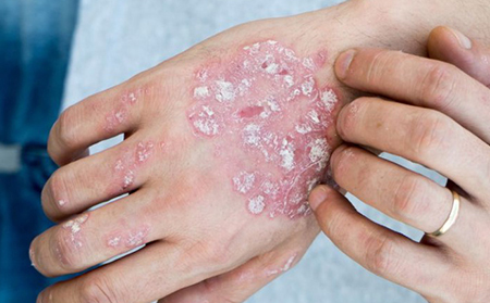 銀屑病病癥動(dòng)態(tài)類型有斑塊/點(diǎn)滴/反向/膿皰/紅皮病型