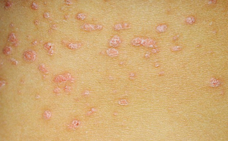 點(diǎn)滴狀銀屑病是銀屑病類型第二常見(jiàn)的。