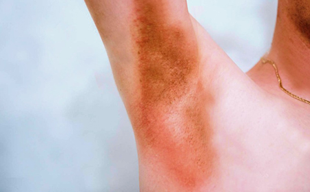 反向銀屑病在超重的人群中比較常見(jiàn)