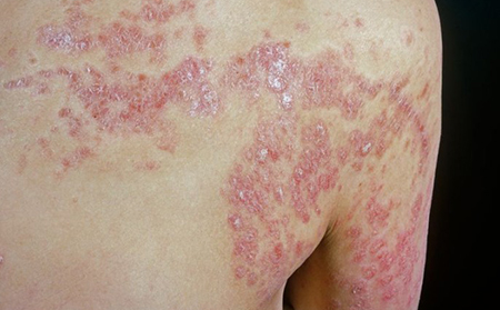 膿皰型銀屑病占銀屑病類型的千分之三