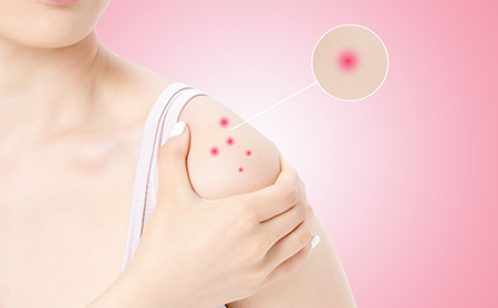 牛皮膚癬的治療取決于3個方面