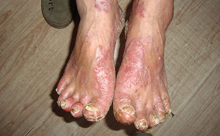 初期指甲銀屑病早期圖片癥狀