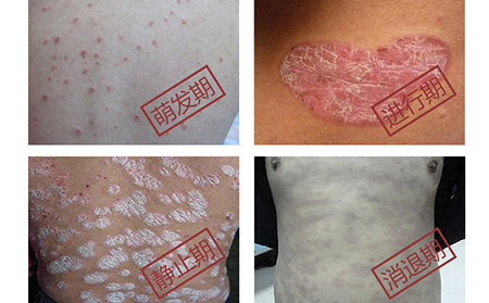 銀屑病癥狀發展過程(圖片)